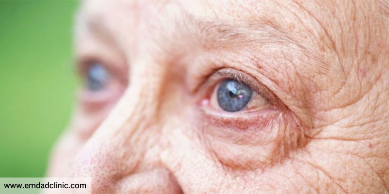 بیماری های شایع چشم در سالمندان