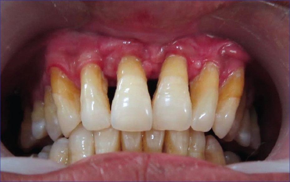 مشکلات شایع دهان و دندان در سالمندان بهداشت پریودنتال
