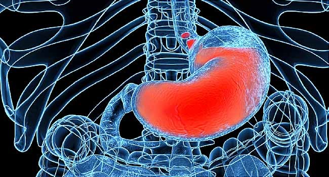 عوامل موثر در ایجاد رفلاکس اسید و سوزش سر دل (معده)