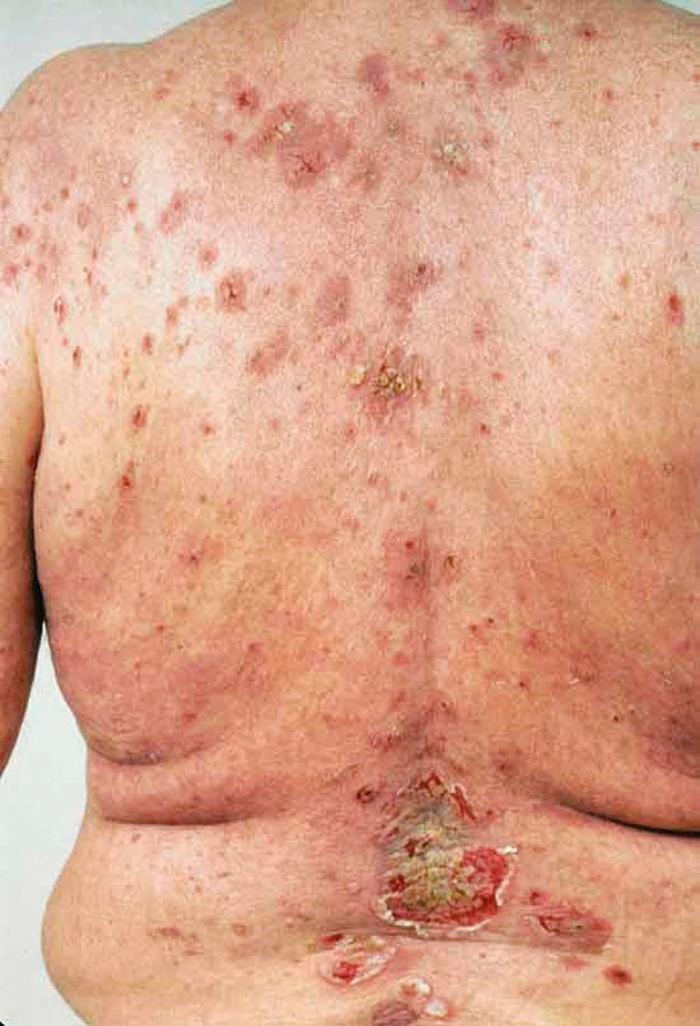 عفونت های پوستی در سالمندان
